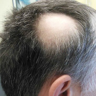 Bald Spot Treatment  Scalp Spot Cream  Hair Loss  Ubuy India